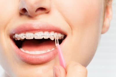 ¿Por qué usar banda elástica en los brackets?